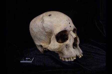 Cranio maschile con tumore