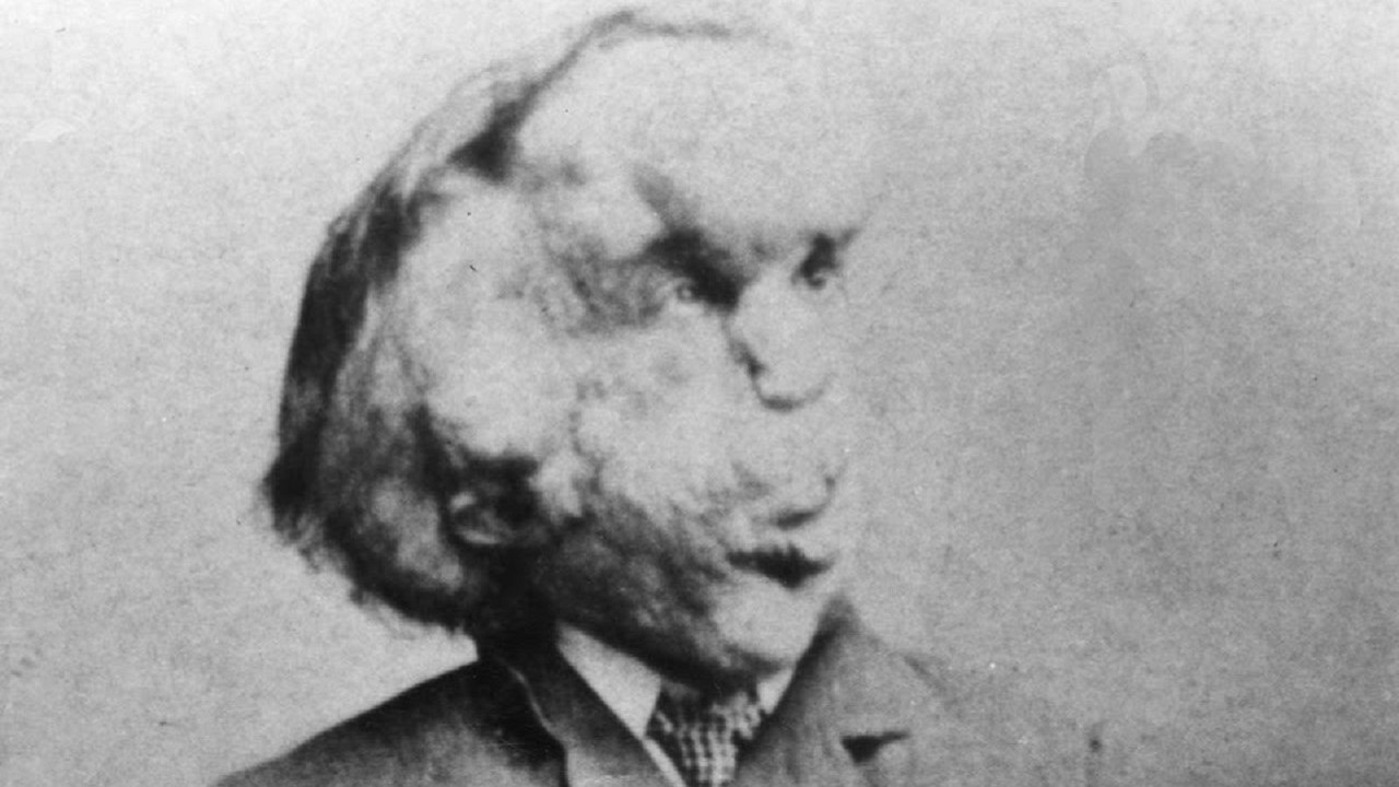 Joseph Merrick nel 1889