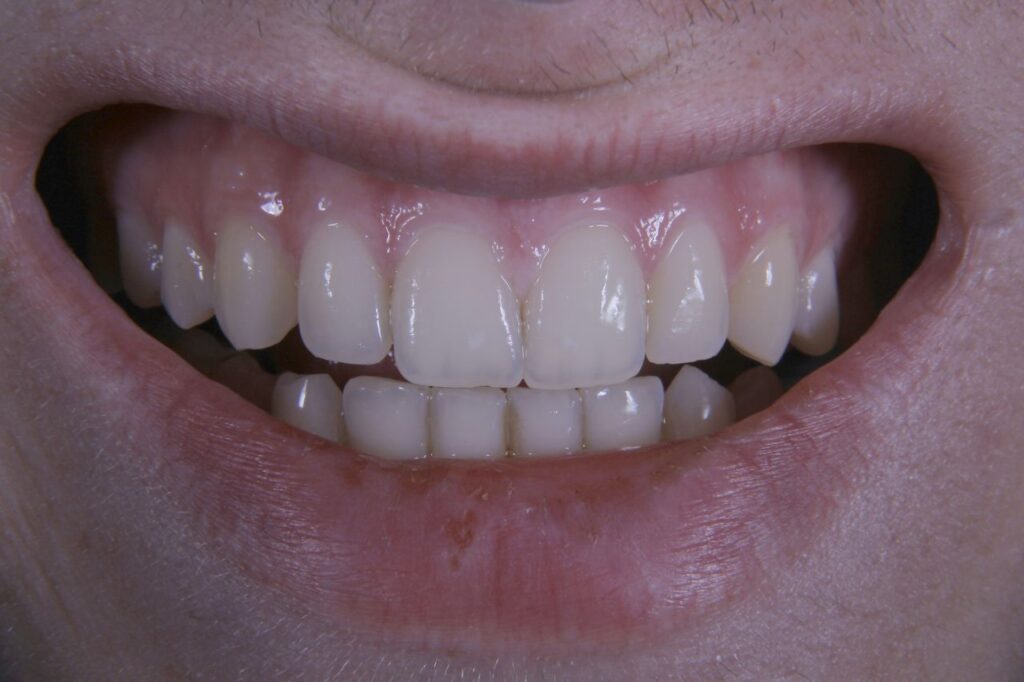 denti