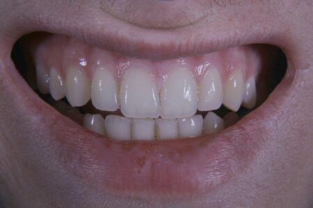 denti