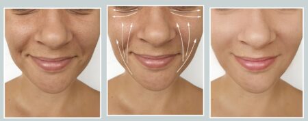 volto di donna che si sottopone a filler