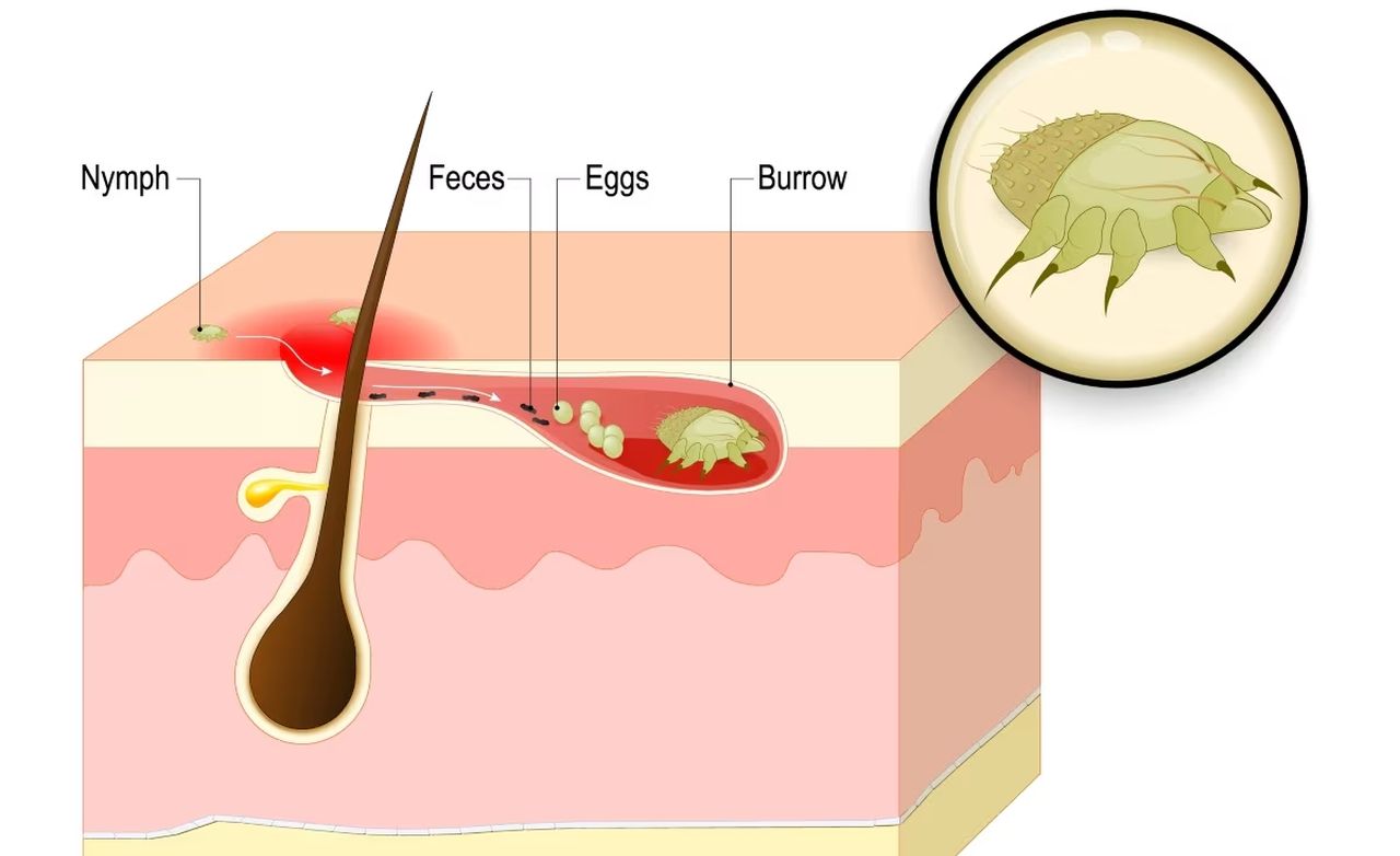 Lo sapete che la scabbia scava cunicoli sotto la pelle? Ecco perché i casi sono triplicati dopo il lockdown