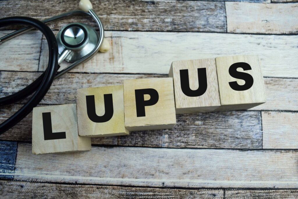 Svolta nello studio del lupus: è connesso al virus della malattia dei baci Cubi di legno che formano la parola Lupus
